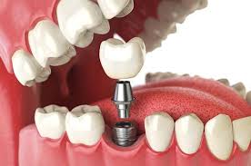 Tooth Extraction Cost in Dubai: What You Need to Know in 2025