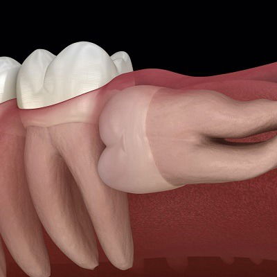 Real Cost of Tooth Extraction in Dubai Without Surprises