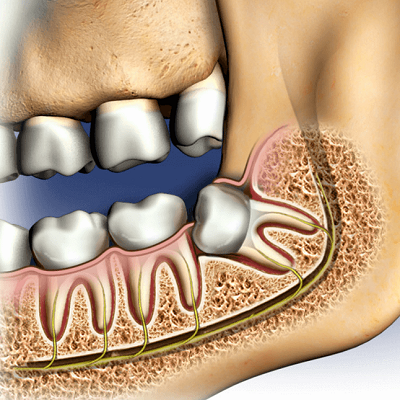 Pay Less for Tooth Extraction