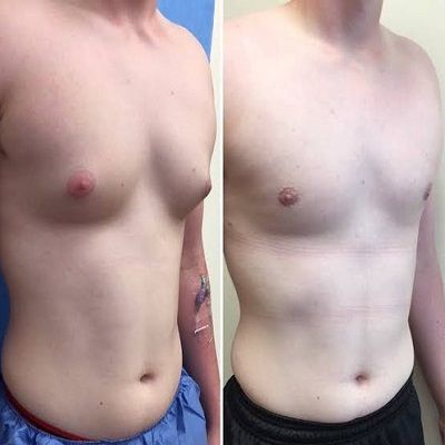 Gynecomastia Surgery Cost: What to Expect