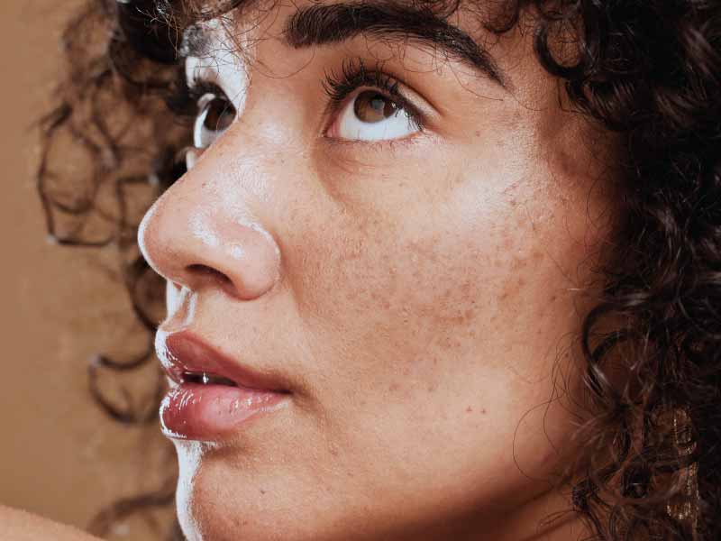 Best Melasma Treatment Options Available