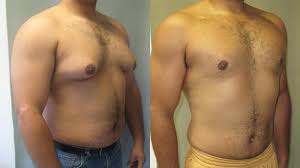 Gynecomastia Surgery Expenses Explained