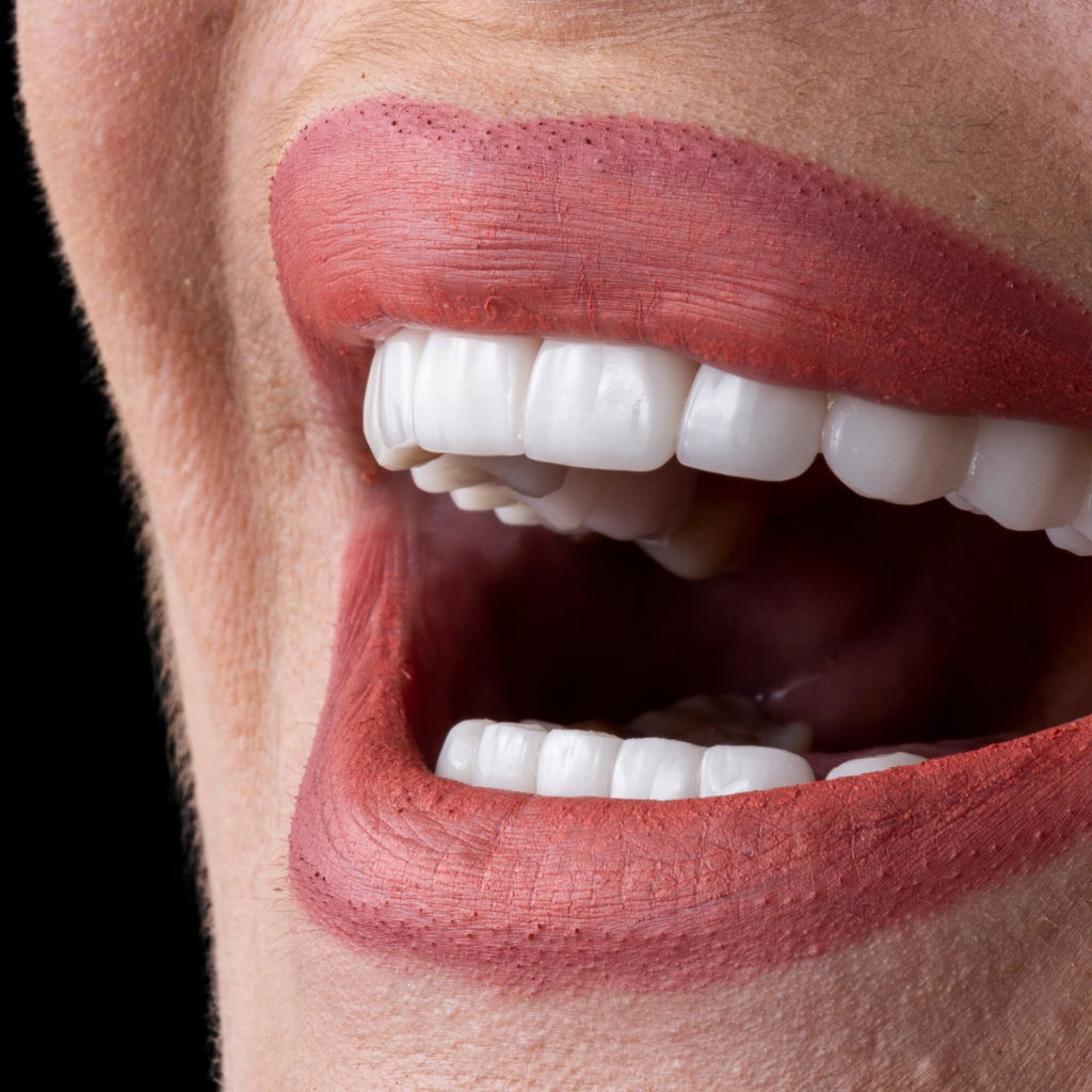Teeth Whitening Cost in Dubai Explained for a Brighter Smile