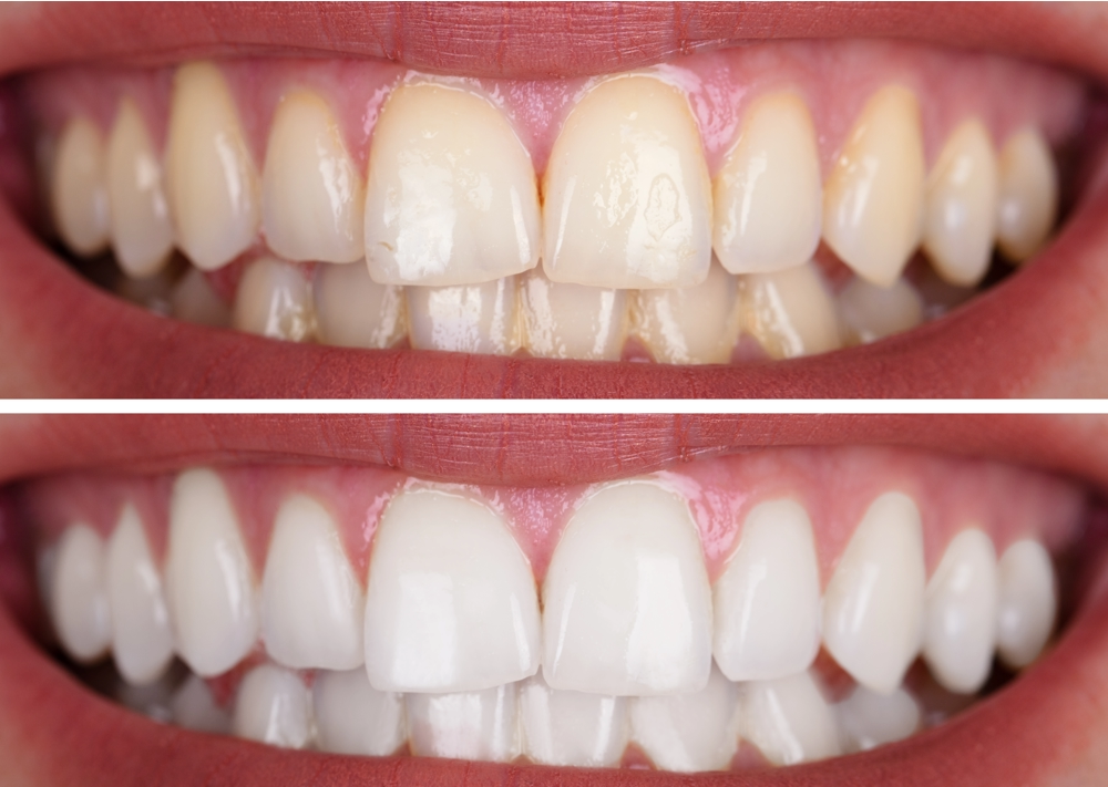 Demystifying the Price of Teeth Whitening Cost in Dubai