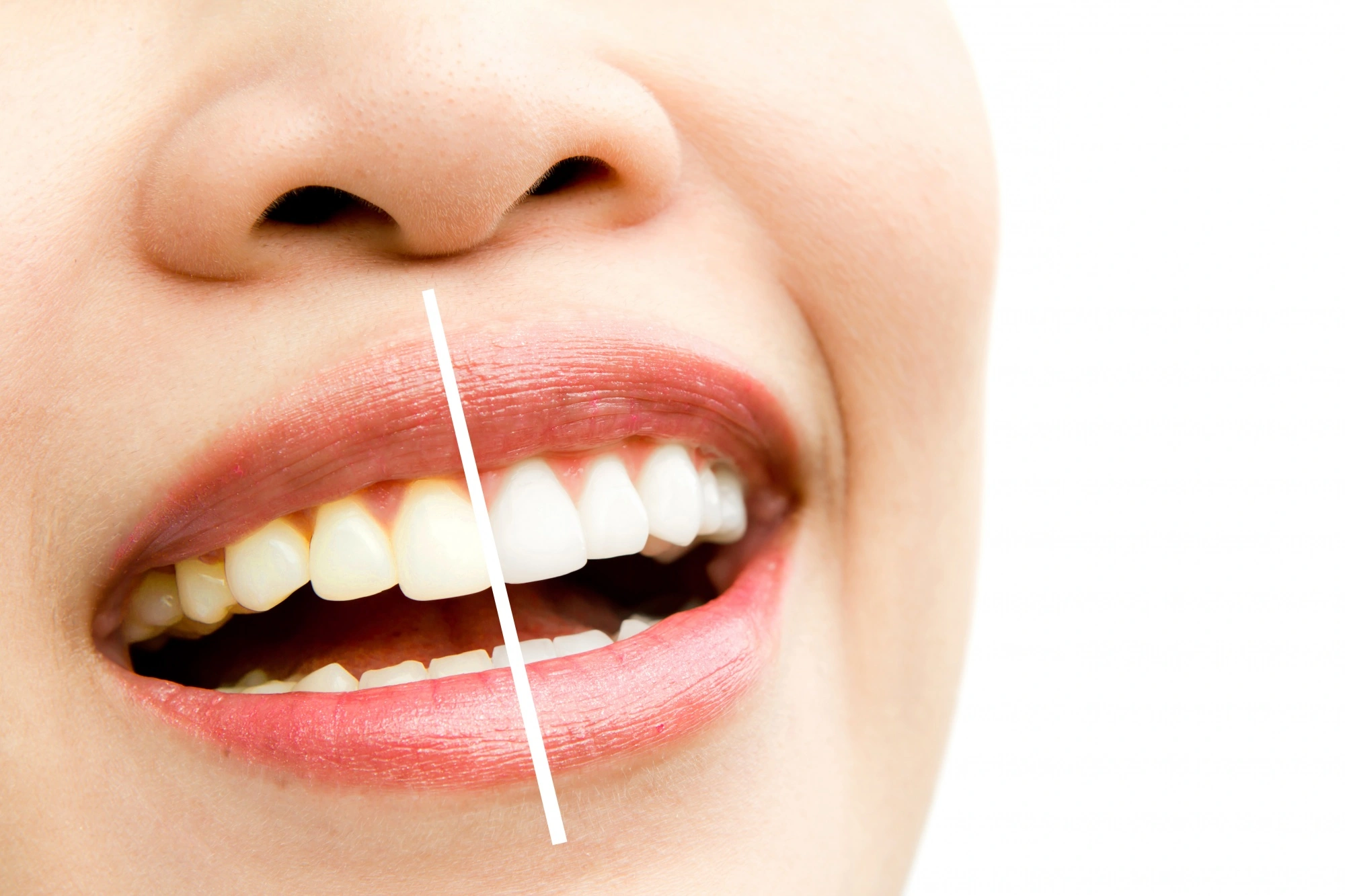 How Much to Budget for Teeth Whitening in Dubai