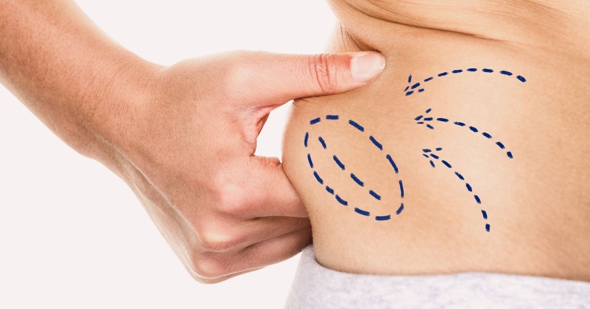 Liposuction Cost Factors to Watch for