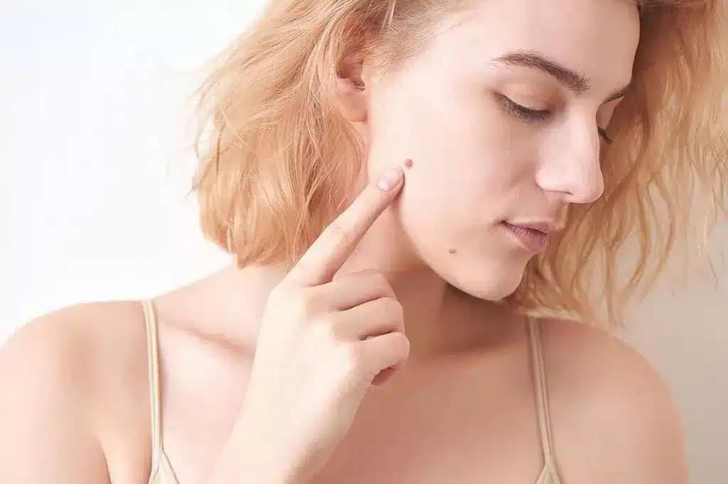 Warts Removal Treatment: Does It Permanently Stop Regrowth?