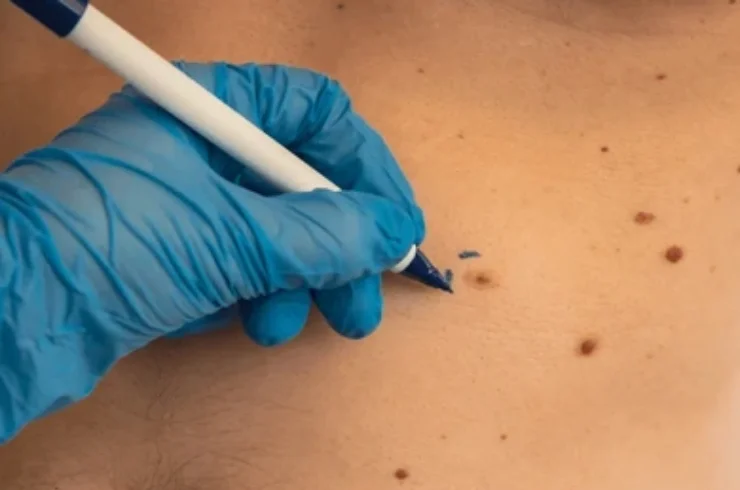 Is Wart Removal Treatment Safe for People with Sensitive Skin?