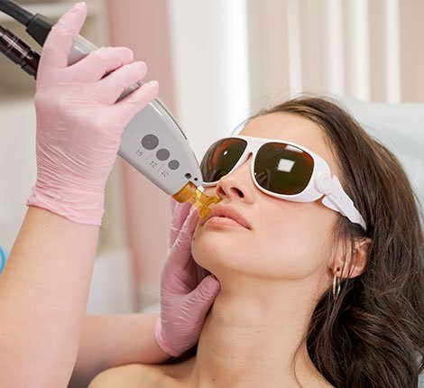 Does Islam Allow Laser Hair Removal for Facial Hair?
