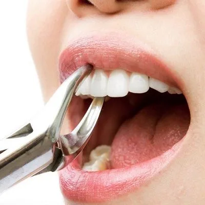 Tooth Extraction Cost: Is It More Expensive for Wisdom Teeth?