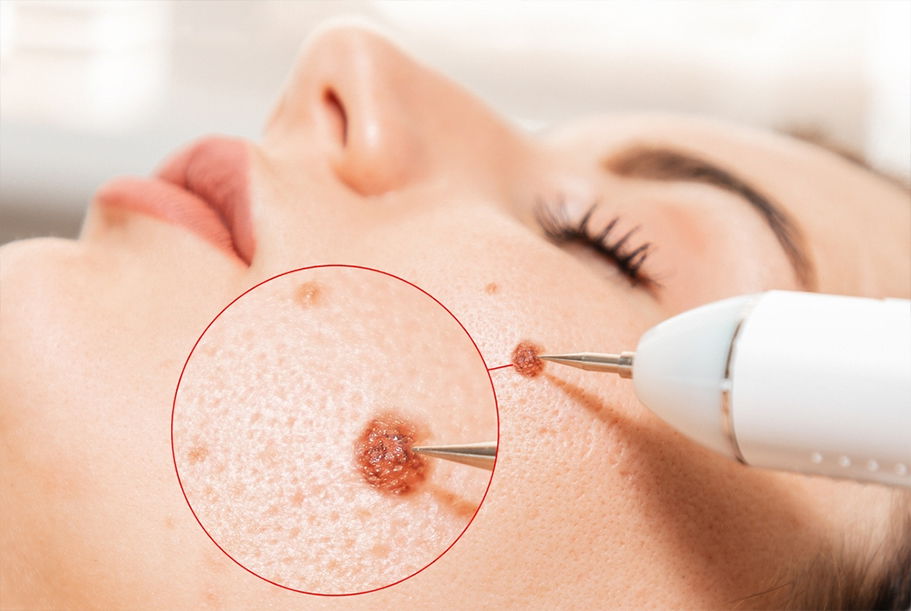 How to Avoid Pain During Warts Removal Treatment Procedures