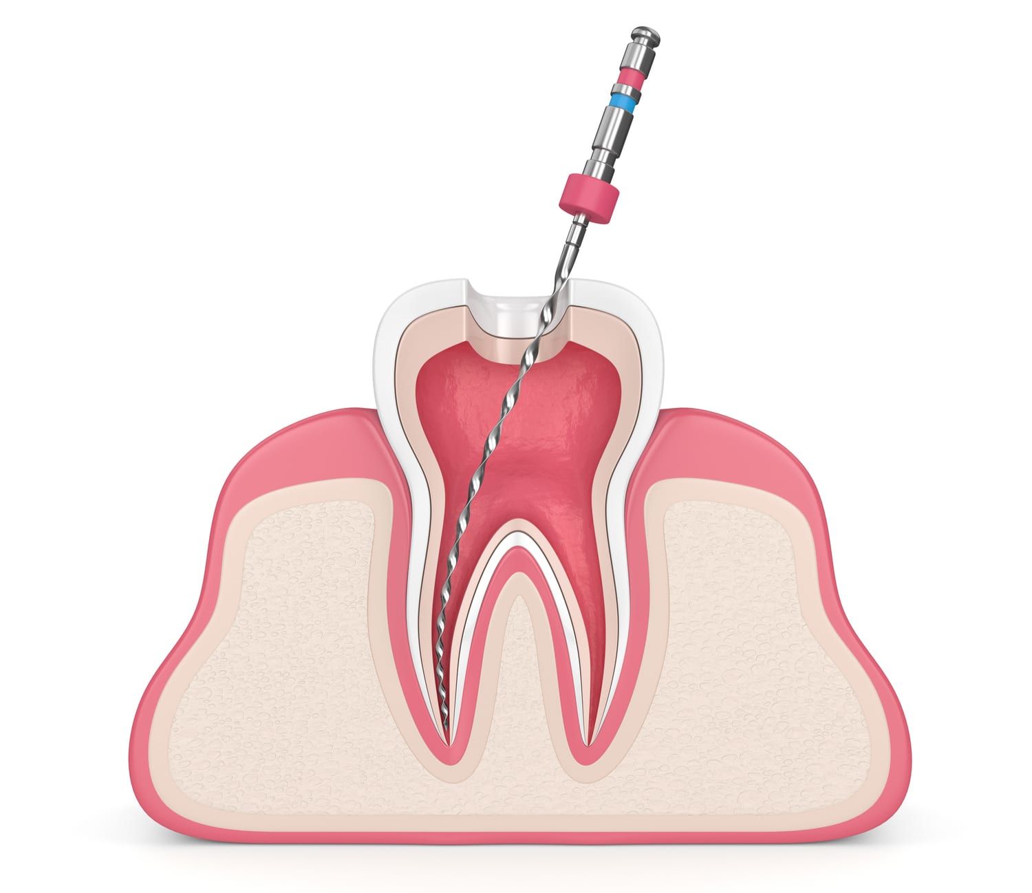 Root Canal Treatment for Cracked Teeth: What You Need