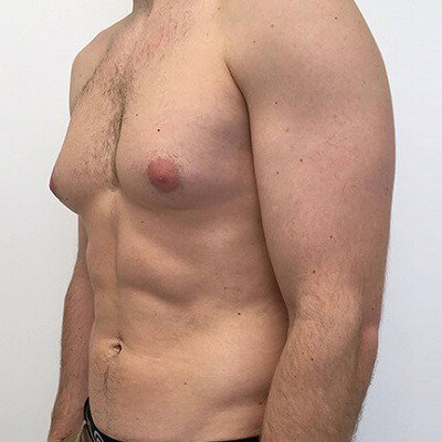 Gynecomastia Surgery and Its Role in Confidence Gain
