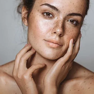Smooth and Clear Skin Made Simple With Advanced Melasma Treatment