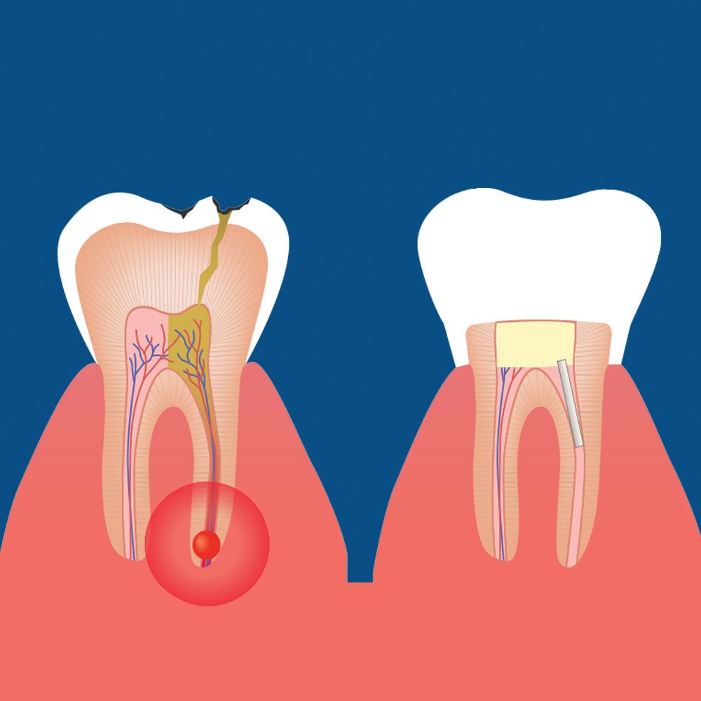 Root Canal Treatment That Makes Oral Care Simple and Easy