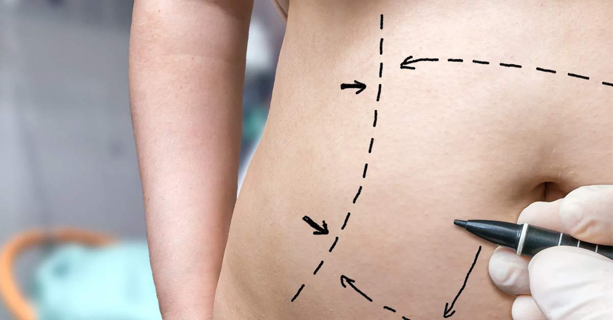 Unlock Confidence and Shape via Laser Liposuction Power