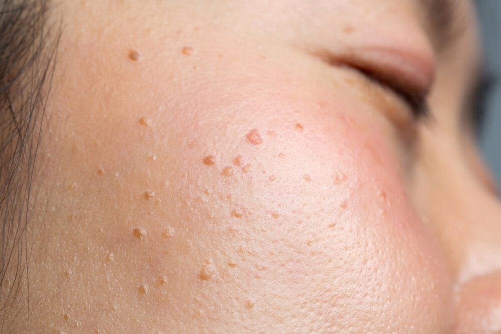 Warts Removal Treatments That Give Your Skin Its Smooth Future
