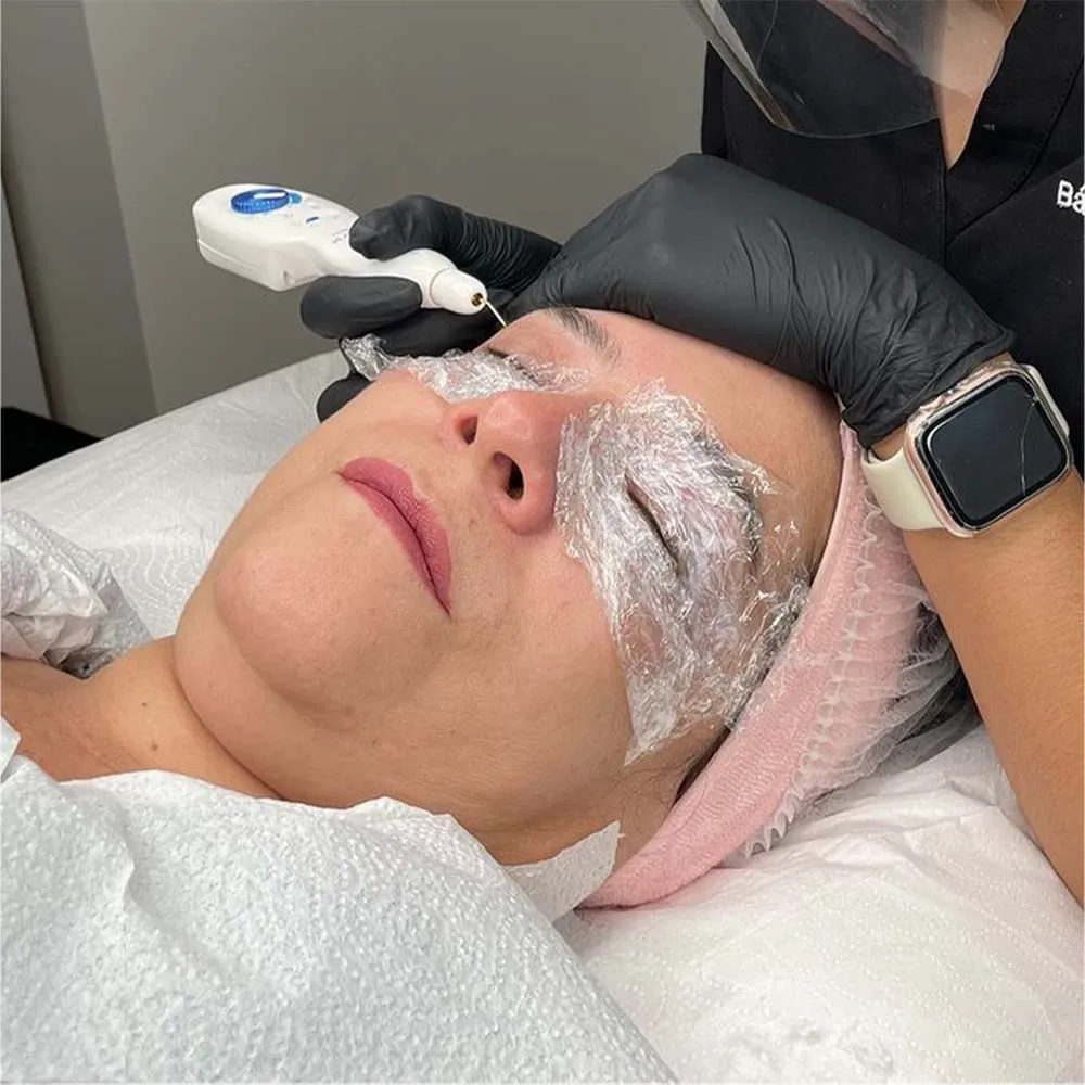 Redefine Your Beauty Journey Using Plasma Pen Treatment