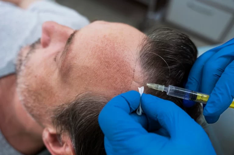 Transform Your Look With Advanced GFC Treatment For Hair Growth