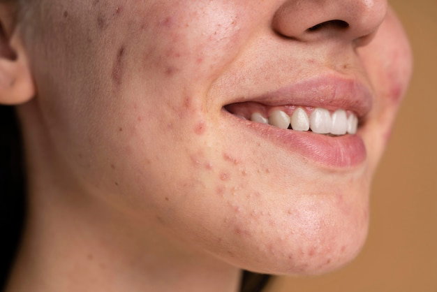 Refresh Skin Glow Quickly With Acne Treatment Dubai Techniques