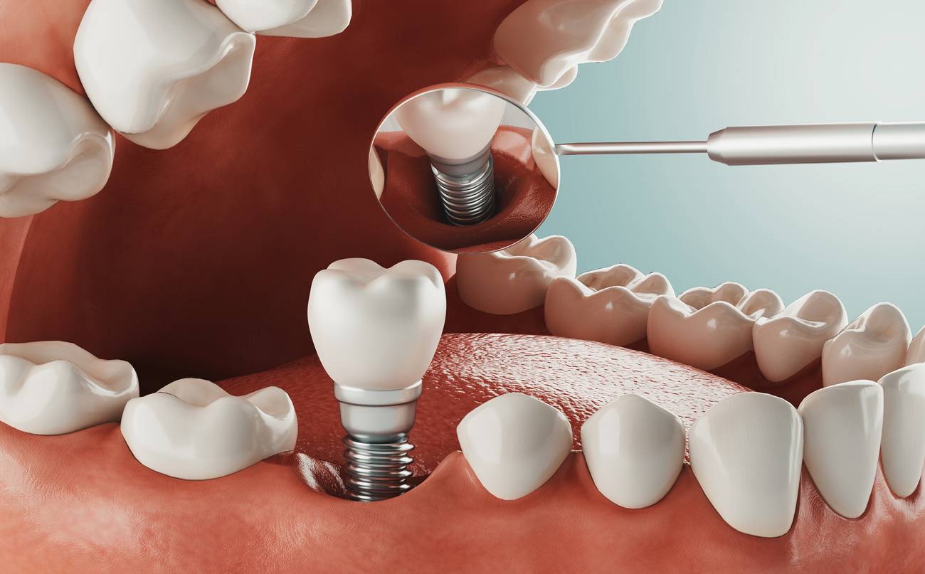 Refresh Your Smile Outlook Through Personalized Single Tooth Implant Cost