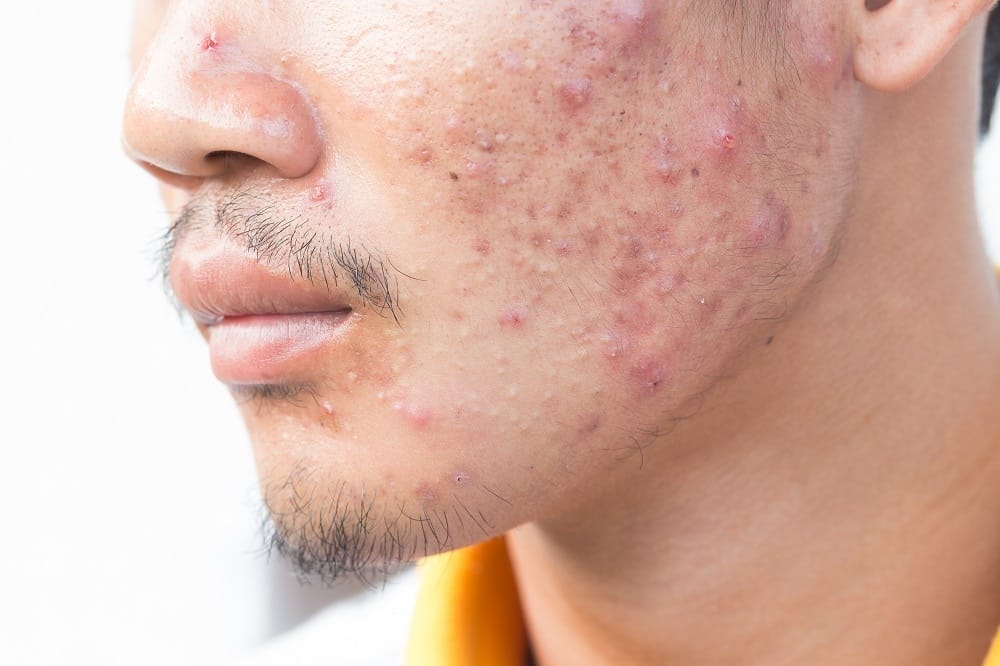 Achieve Smooth, Radiant Skin Fast with Acne Treatment Dubai