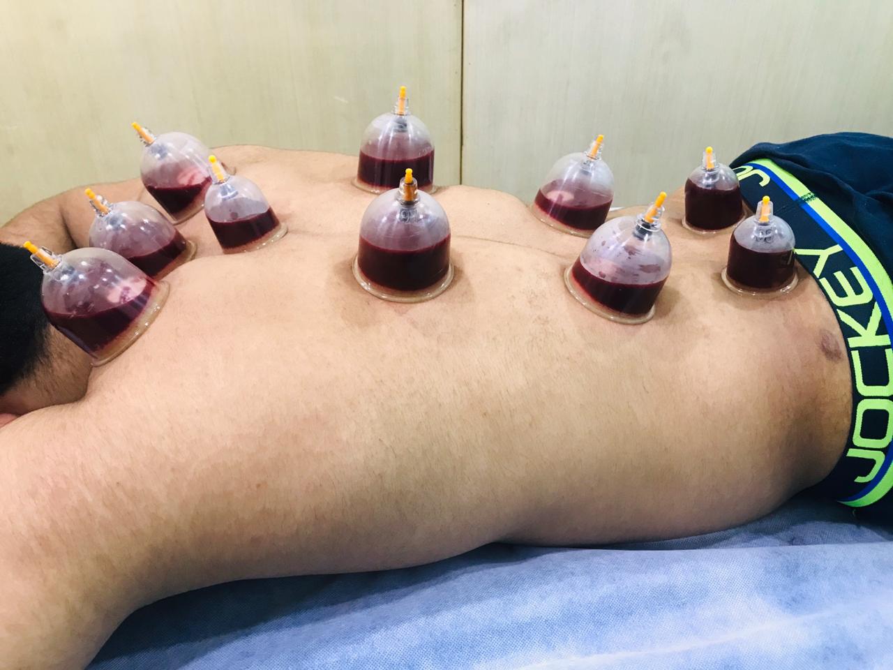 Revive Mind and Body Quickly Using Hijama Cupping Therapy Techniques