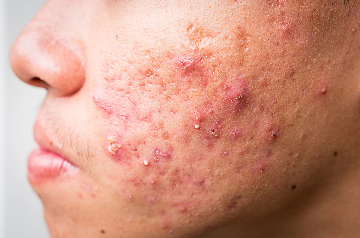 Reveal Skin Perfection Instantly with Acne Treatment Dubai