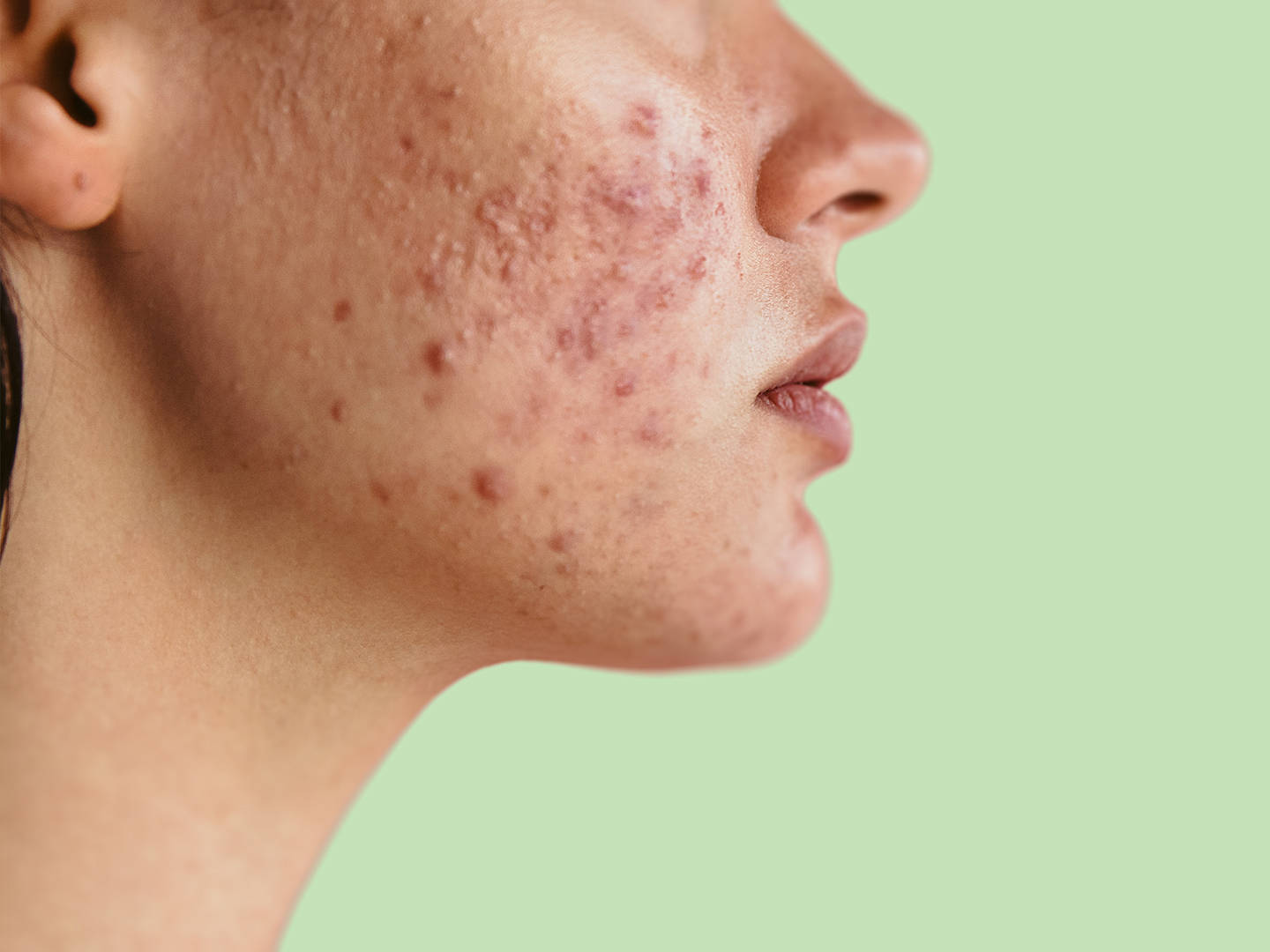 Unlock Perfect Skin Fast Through Acne Treatment Dubai