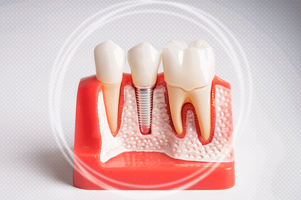 Reveal Bold Charm Today With Single Tooth Implant Cost Tips