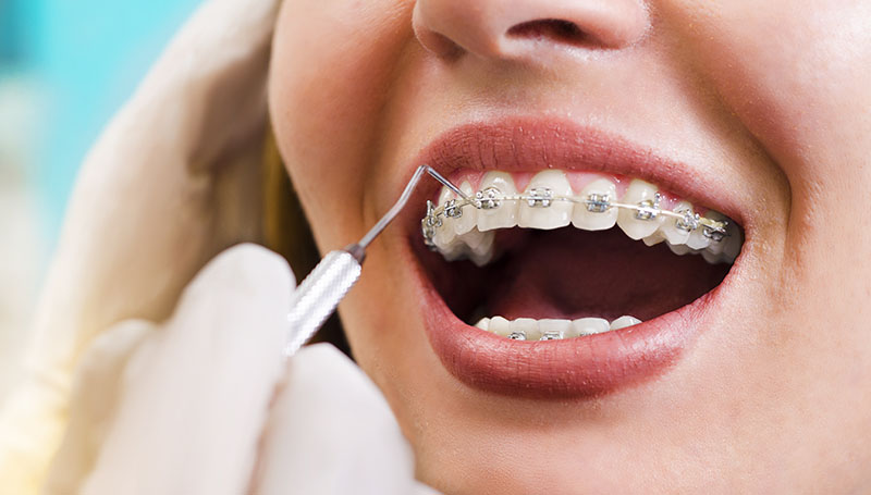 Maximize Your Smile Potential with Teeth Braces Costs Guide
