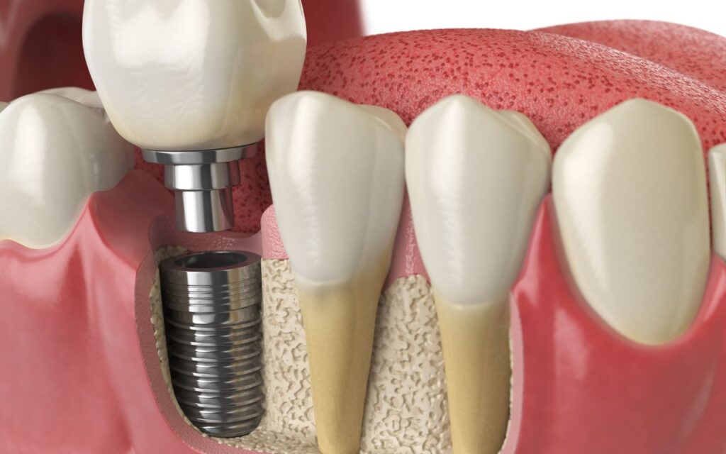 Achieve Lasting Beauty with Single Tooth Implant Cost