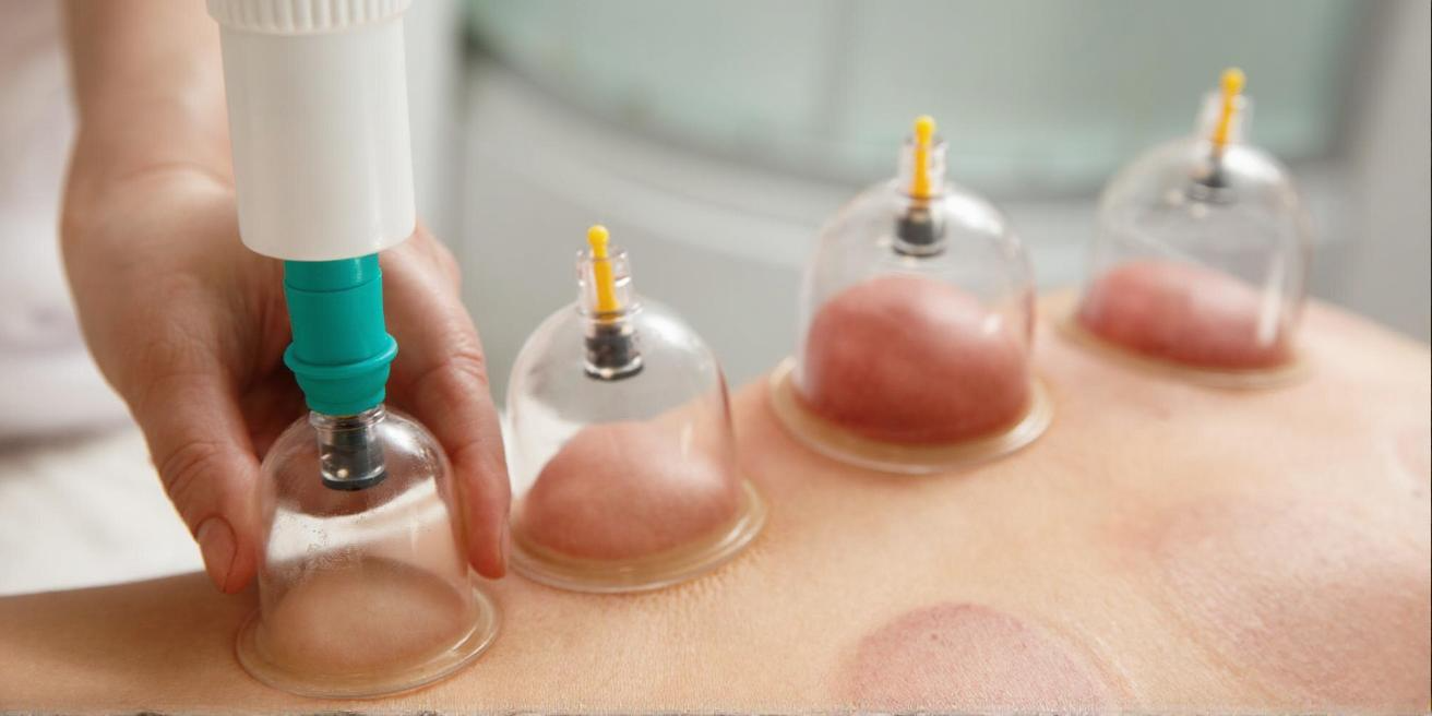 Boost Your Wellness Instantly Through Hijama Cupping Therapy
