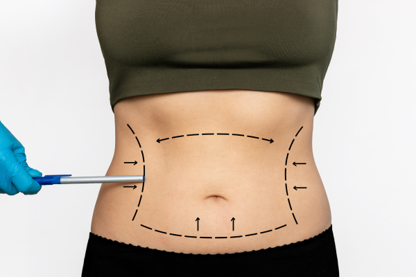 Experience Next-Level Contouring with Laser Liposuction