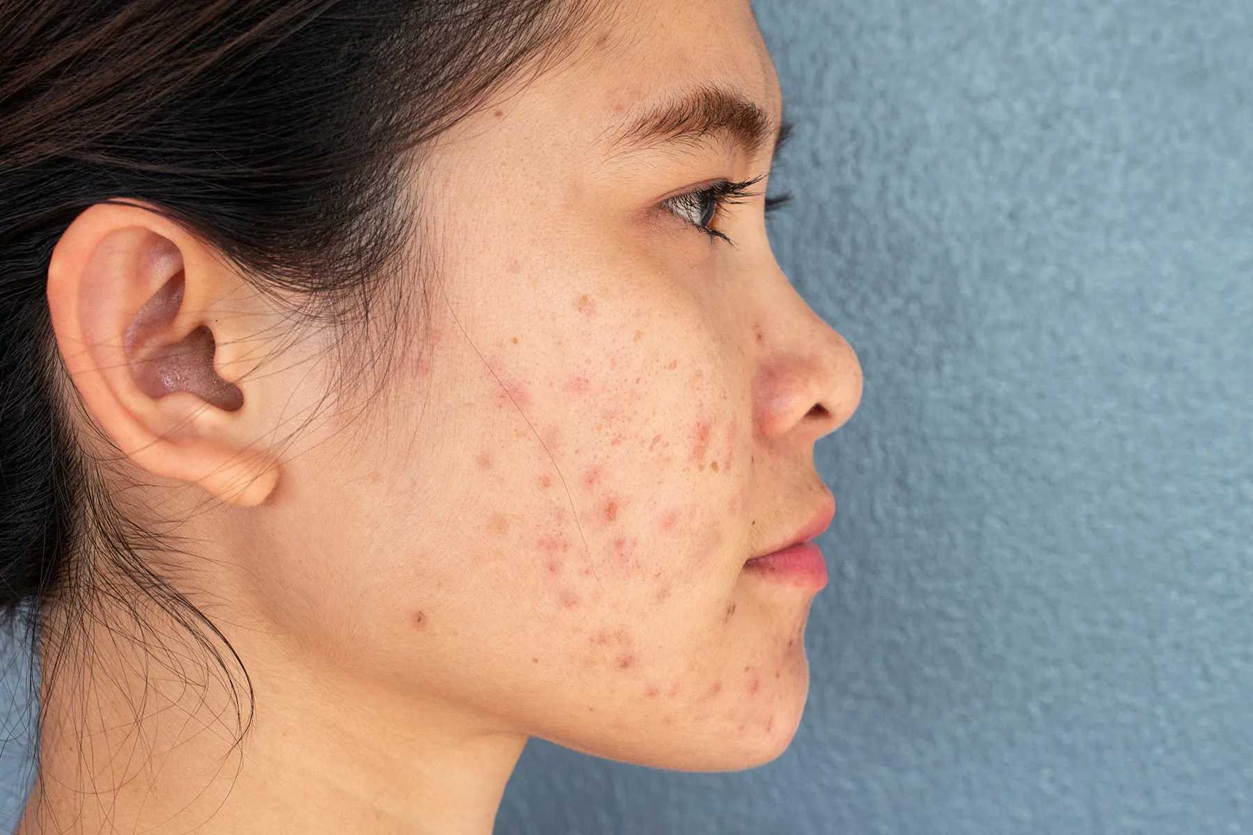 Boost Confidence Instantly with Brad Pitt’s Acne Scar Treatment