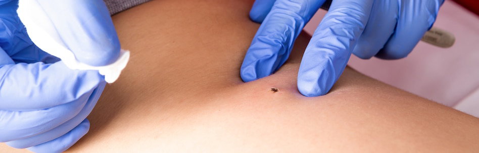 Achieve Flawless Skin Using Powerful Warts Removal Treatments