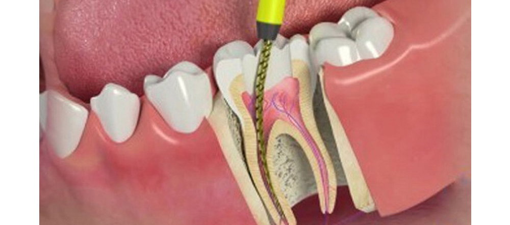 Root Canal Treatment That Saves Teeth and Enhances Oral Health