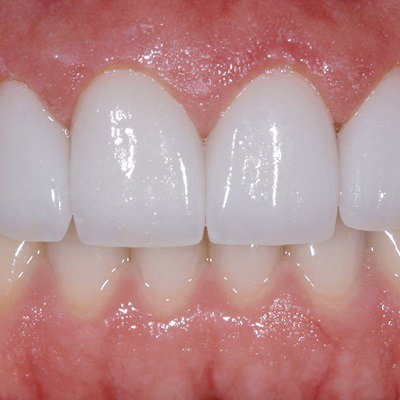 Boost Your Confidence with Perfectly Crafted Composite Veneers