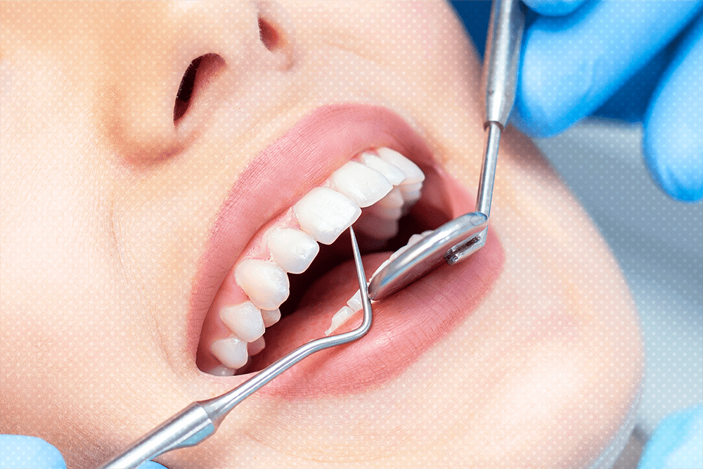 Dental Veneers Cost Secrets To Unlock Your Perfect Smile Instantly)
