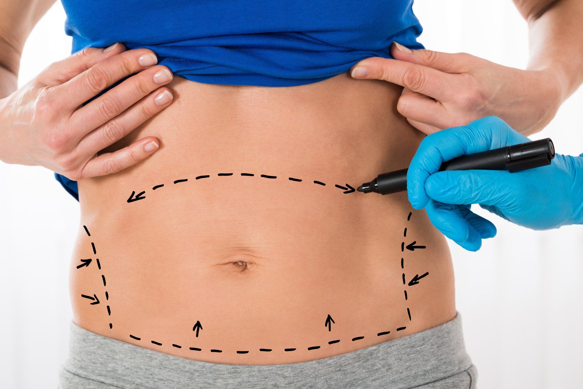 Tummy Tuck Helps You Reveal a Flatter and Firmer Midsection