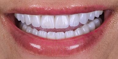 Non-Prep Veneers Redefine Smile Beauty Through Effortless Bright Harmony
