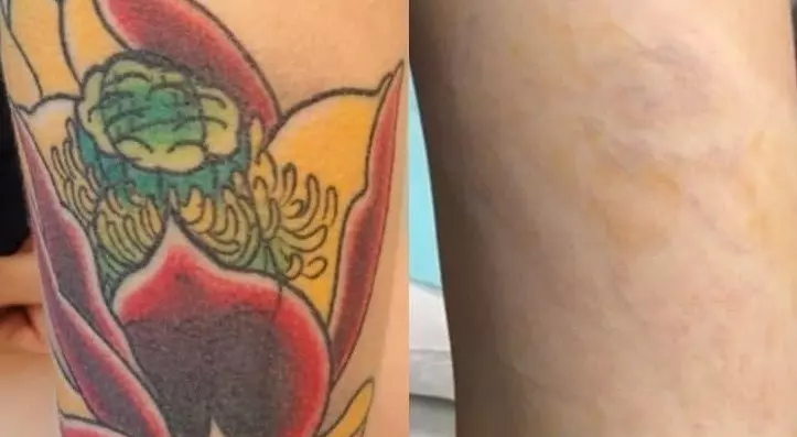 Laser Tattoo Removal Deep Ink Breakthrough For Clear Skin Glow