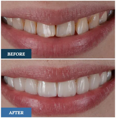 What to Know About Getting Dental Veneers in Dubai