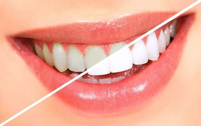 Brighter Smiles with Teeth Whitening in Dubai