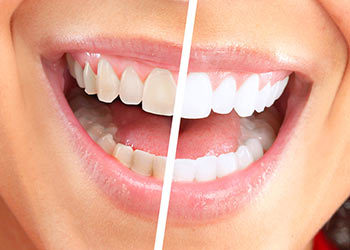 Achieving a Radiant Smile: Teeth Whitening in Dubai