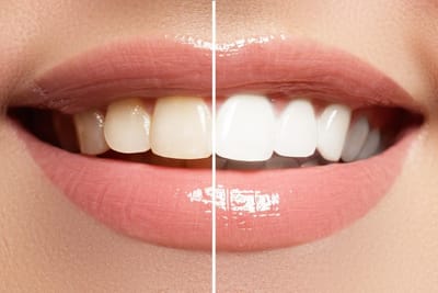 Debunking Myths: What Really Works for a Whiter Smile?