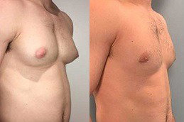 Achieve a Toned and Masculine Chest with Gynecomastia Treatment in Dubai