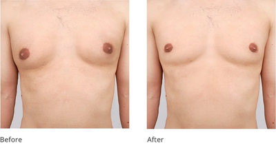 Best Surgical Solution for Male Breast Reduction