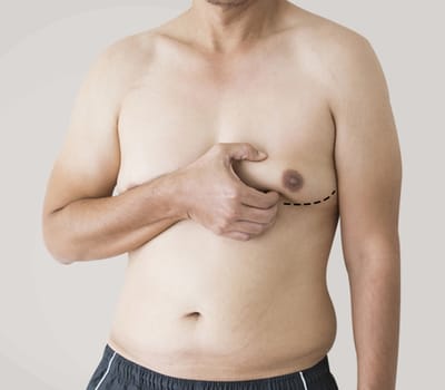 Gynecomastia Surgery for a Confident You