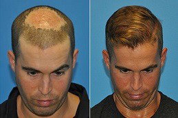 Finasteride for Baldness: Success Rates & Benefits